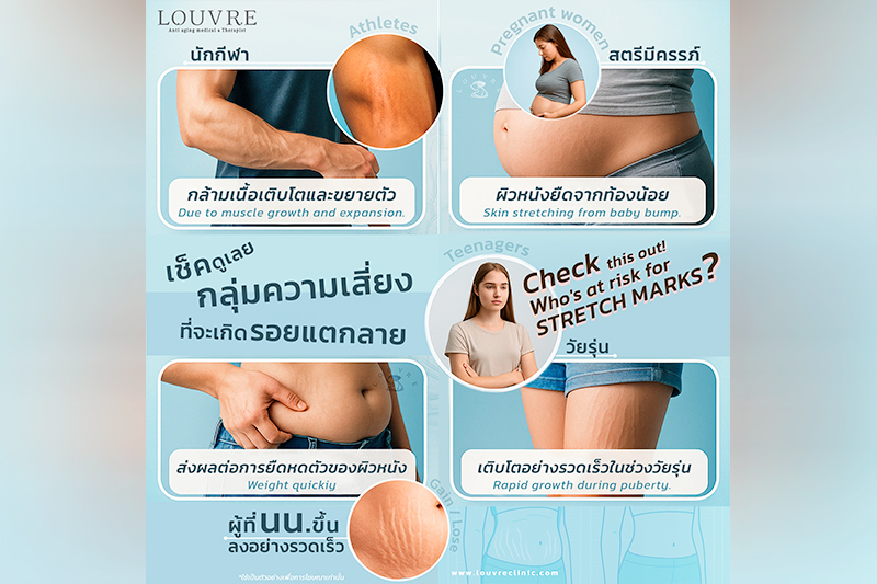 กลุ่มเสี่ยง “รอยแตกลาย” ที่อาจไม่รู้ตัว