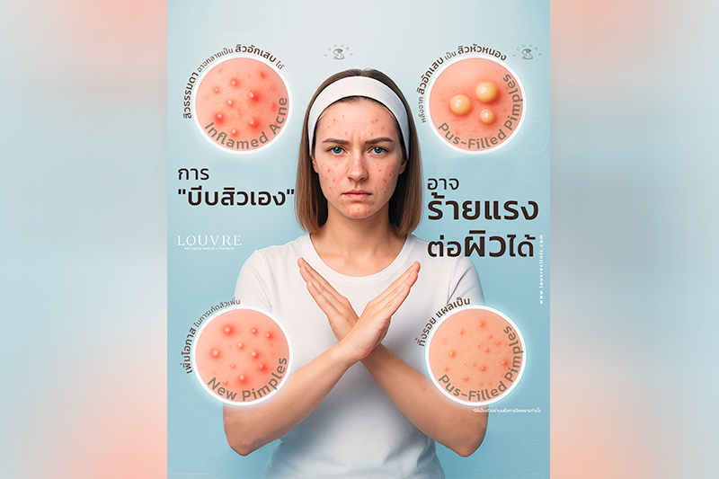 การบีบสิวเองอาจทำร้ายผิวได้